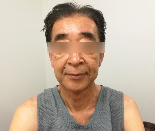 After：施術後の状態