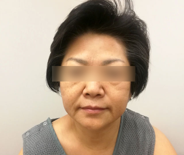 Before：施術前の状態