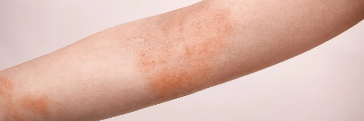 「腕に現れた湿疹や皮膚炎、肌のかゆみのイメージ（名古屋市千種区本山 テソラ治療院）」