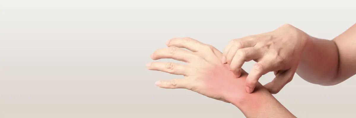 ラテックスアレルギーによる腕の赤みとかゆみを掻いている様子
